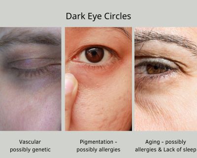 Dark Circles